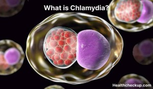 Chlamydia Symptoms Diagnosis Treatment Prevention