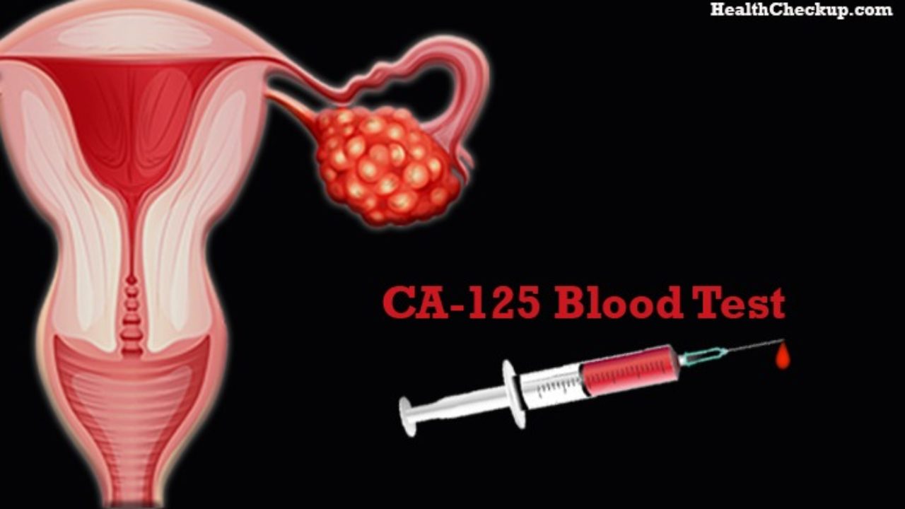 CA-125 Blood Test for Ovarian Cancer | CA-125 Blood Test Normal Levels