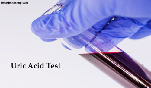 Uric Acid Test Normal Range,Procedure | Symptoms,Causes of Uric Acid