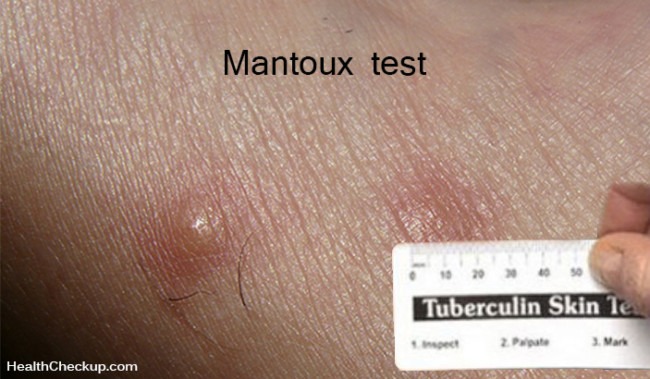 mantoux-skin-test-procedure-results-interpretation-risks