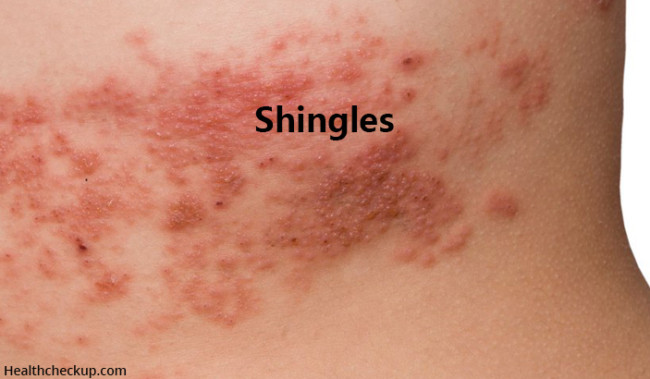 Herpes Zoster or Shingles Symptoms and Treatment | Healthcheckup