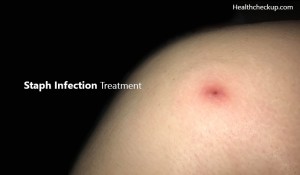 Staph Infection Treatment | Symptoms of Staph Infection | Health Checkup