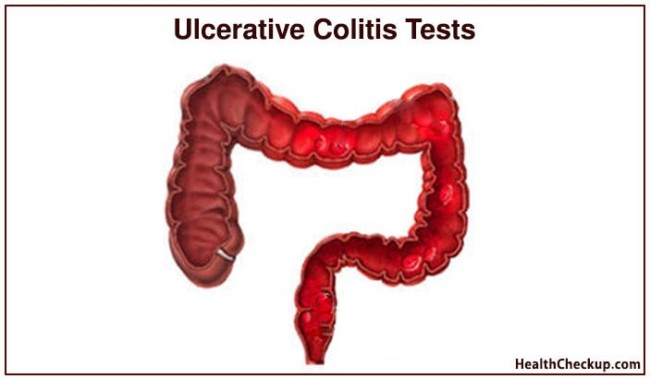 Ulcerative Colitis Tests | Symptoms,Causes of Ulcerative Colitis