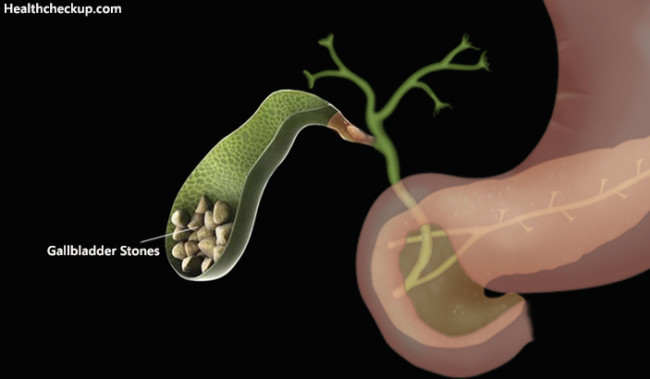 Test for Gallbladder Function, Gallstones & Gallbladder Cancer