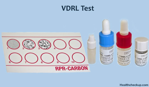 What is a VDRL Test : Procedure, Purpose, Results, Interpretation