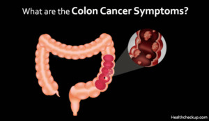 Colon Cancer Symptoms and Stages in Males, Females
