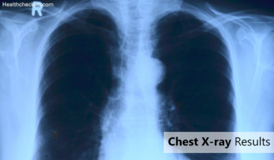 Chest X-ray Results : Test Procedure, Preparation and Risks