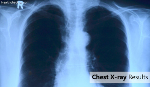 x ray risks
