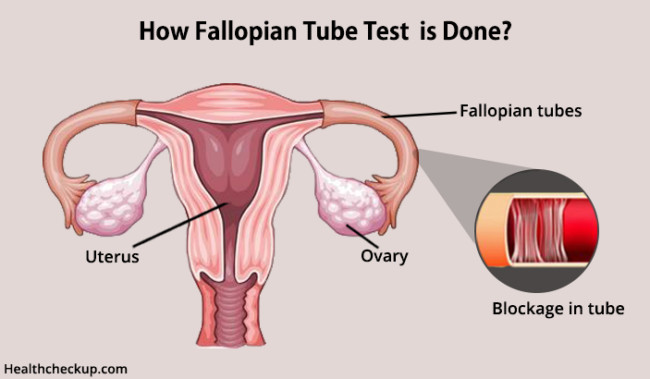 What Causes Fallopian Tube