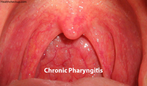 chronic-pharyngitis-types-causes-symptoms-diagnosis-treatment