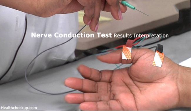 Nerve Conduction Test Results Interpretation - Health CheckUp