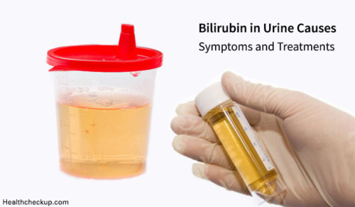 Bilirubin in Urine Causes, Symptoms and Treatments | Bilirubin Levels ...