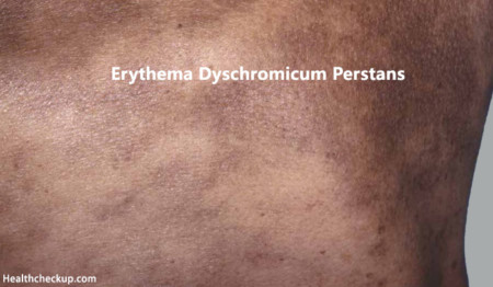 Erythema Dyschromicum Perstans(Ashy Dermatosis)- Causes & Treatment