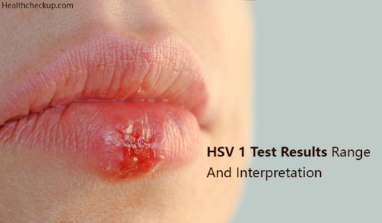 HSV 1 Test Results Range And Interpretation 550x321 