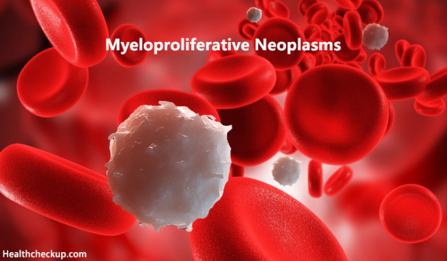 myeloproliferative-neoplasms-mpns-symptoms-treatment-survival-rate