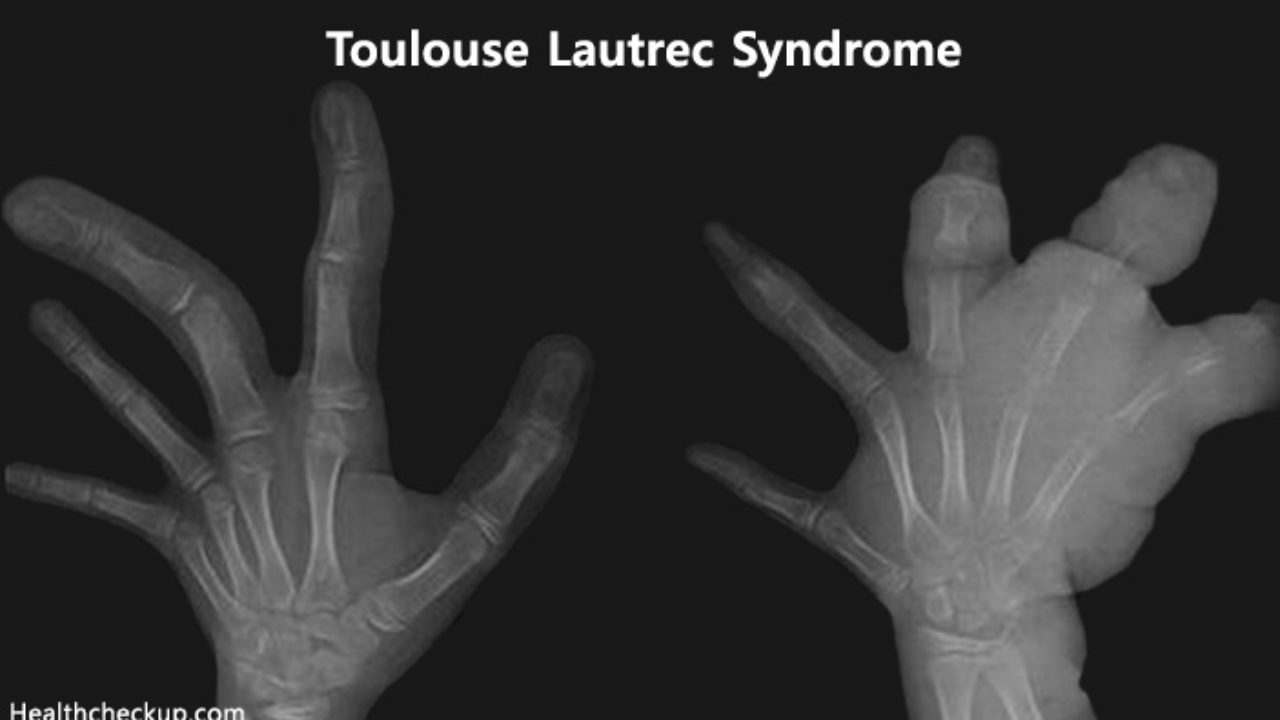 Toulouse Lautrec Syndrome Pycnodysostosis Causes Signs Treatment