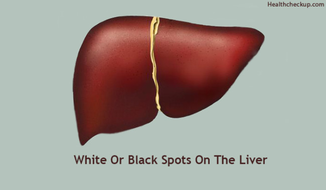 black-or-white-spots-on-liver-what-does-it-mean-causes-by-dr-himanshi