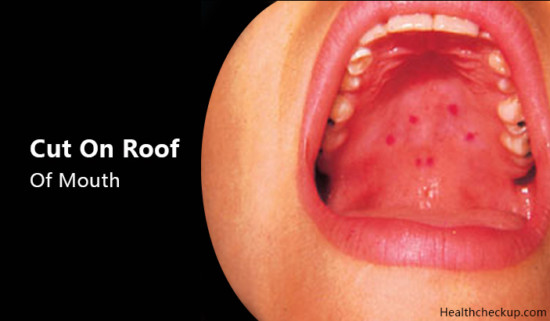 Cut On Roof Of Mouth Causes Treatment Prevention By Dr Himanshi