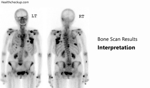 Bone Scan Results Interpretation Bone Scan Side Effects Health Checkup