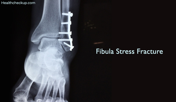 What Is Fibula Stress Fracture Symptoms Causes Treatm