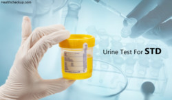 Can Urine Test Detect STD | What Does a Urine Test Show