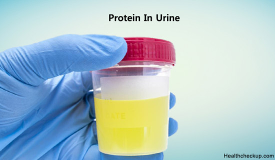 Protein In Urine Normal Low High Ranges Signstypes Of Proteinuria 8054