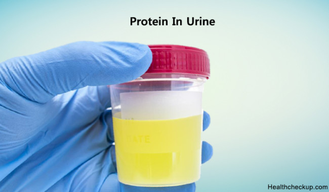 Protein in Urine Normal, Low, High Ranges | Signs,Types of Proteinuria