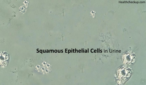 Squamous Epithelial Cells in Urine: Causes, Test, Results and Treatment