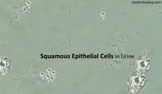 Squamous Epithelial Cells In Urine Causes Test Results And Treatment 7307