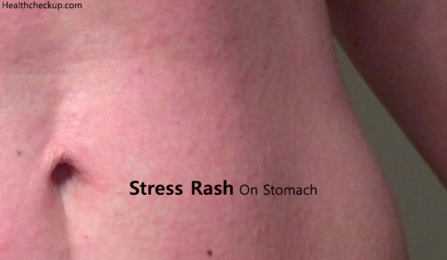 cashew allergy stomach rash