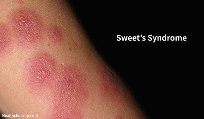 Sweet's Syndrome Causes, Symptoms, Treatment, Complications