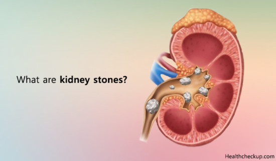 types-of-kidney-stones-and-treatment-signs-symptoms-of-kidney-stones