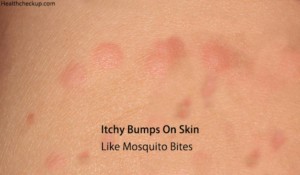 Itchy Bumps on Skin like Mosquito Bites - Causes, Treatment, Prevention