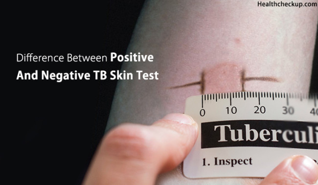 false positive normal negative tb test pictures