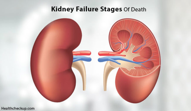 what-are-the-kidney-failure-stages-of-death-health-checkup