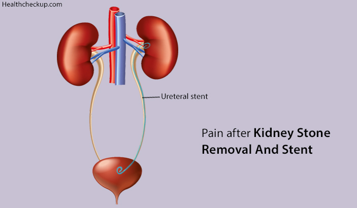 Pain After Kidney Stone Removal And Stent Causes Symptoms Treatment 