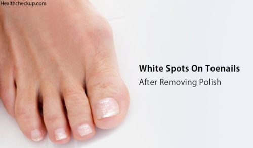 white-spots-on-toenails-its-nature-causes-prevention-and-treatment