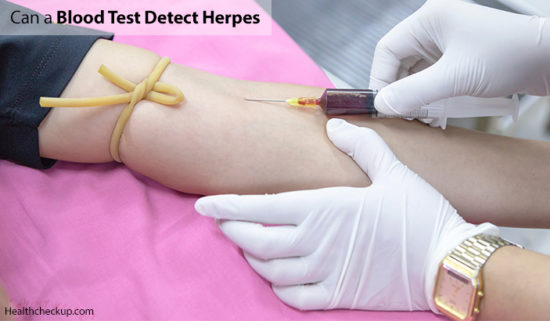 can-a-blood-test-detect-herpes-health-checkup