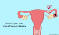 What To Expect After Ectopic Pregnancy Surgery by Dr. Himanshi