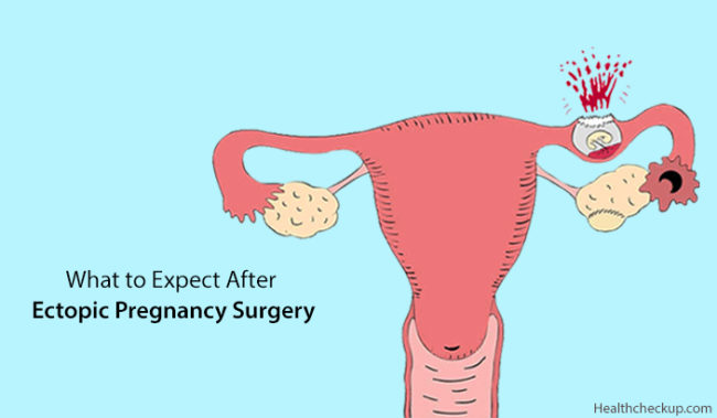 Pain After Ectopic Pregnancy Surgery