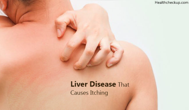 liver-disease-that-cause-itching