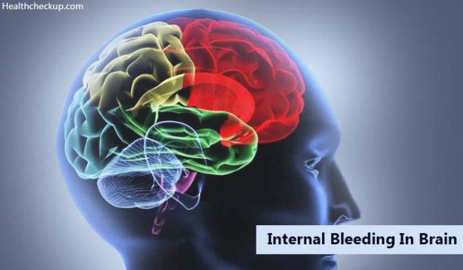 brain-hemorrhage-bleeding-causes-symptoms-treatments