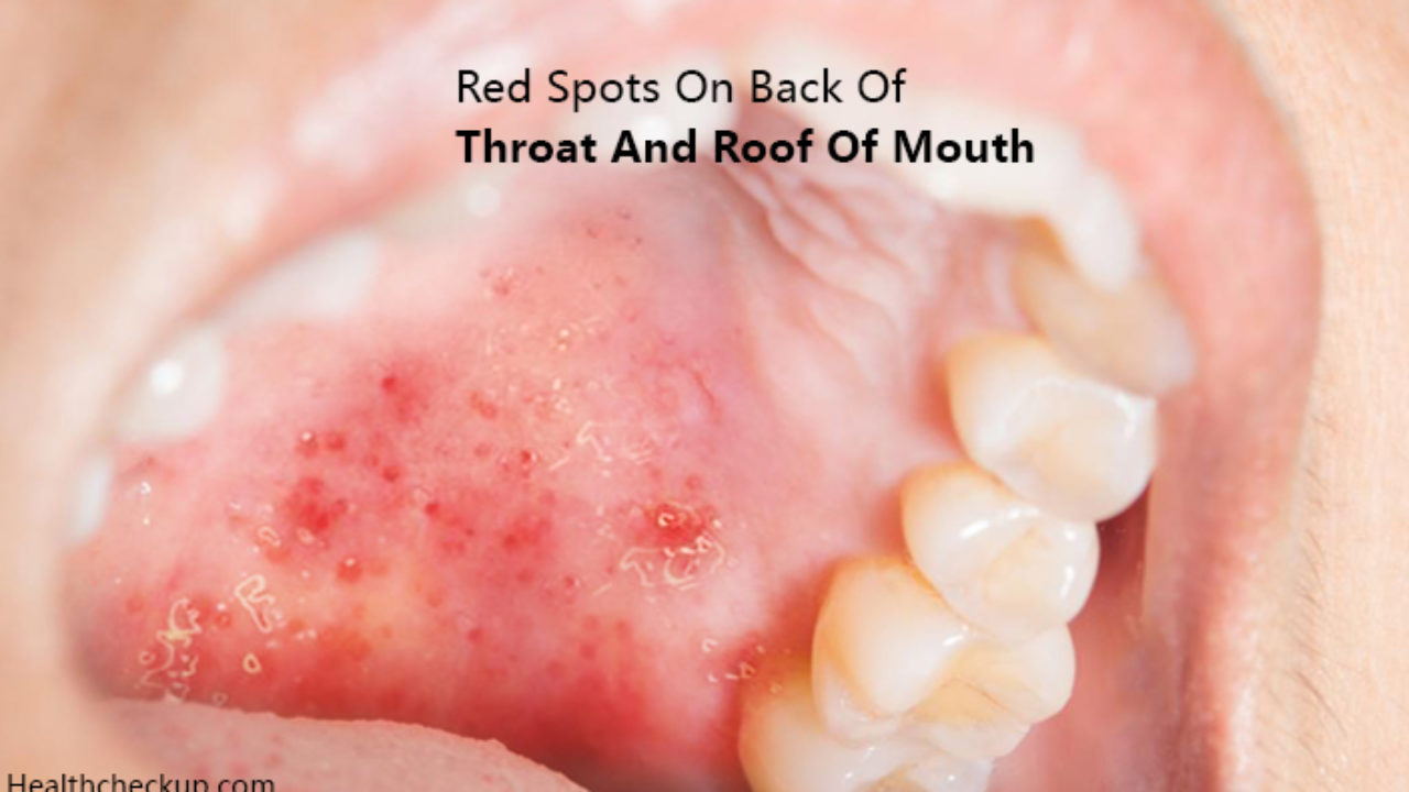 Itchy Red Spots On Roof Of Mouth