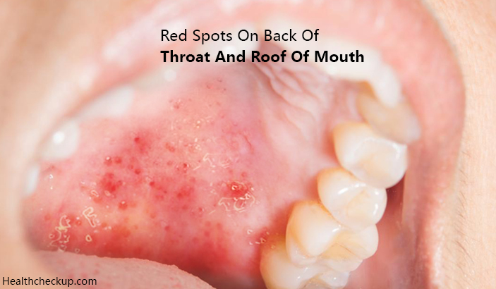 Tiny Bumps On Mouth Roof Can I See A Picture Of Canker Sores On The Roof Of Mouth The