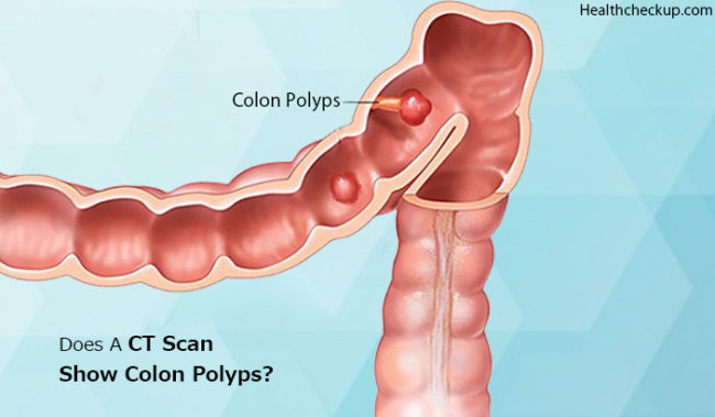Does A Ct Scan Show Colon Polyps By Dr Chathuri