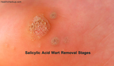 wart salicylic removal plantar warts healthcheckup