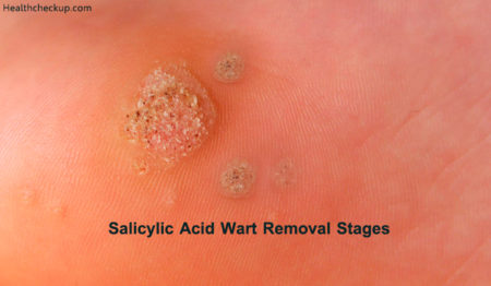 Stages Of Wart Removal Using Salicylic Acid By Dr. Ahmed