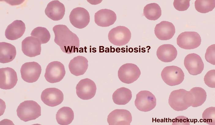 Babesiosis - Symptoms, Diagnosis, Treatment, Prevention