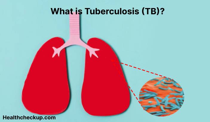 Tuberculosis (TB) - Symptoms, Diagnosis, Treatment, Prevention