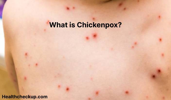 Chickenpox - Symptoms, Diagnosis, Treatment, Prevention